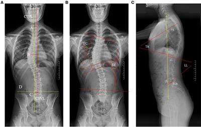 Coronal Balance vs. Sagittal Profile in Adolescent Idiopathic Scoliosis, Are They Correlated?